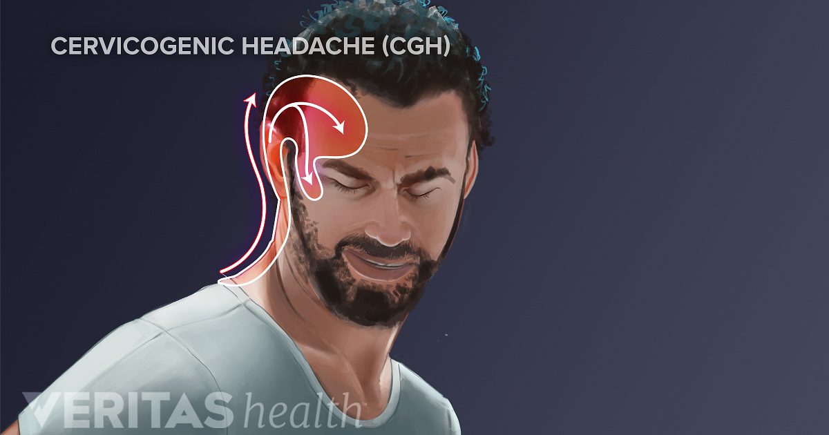 Neck Pain And Cervicogenic Headache