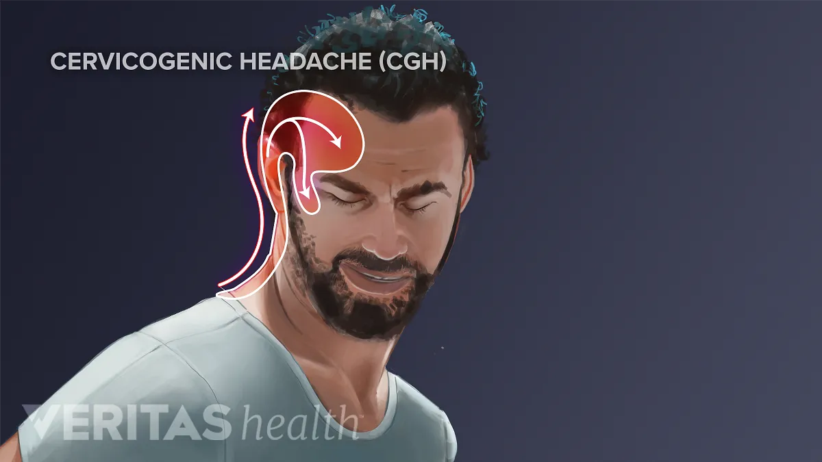 Intermittent pain in 2025 side of neck