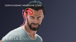 Illustration showing the swath of pain caused by a cervicogenic headache