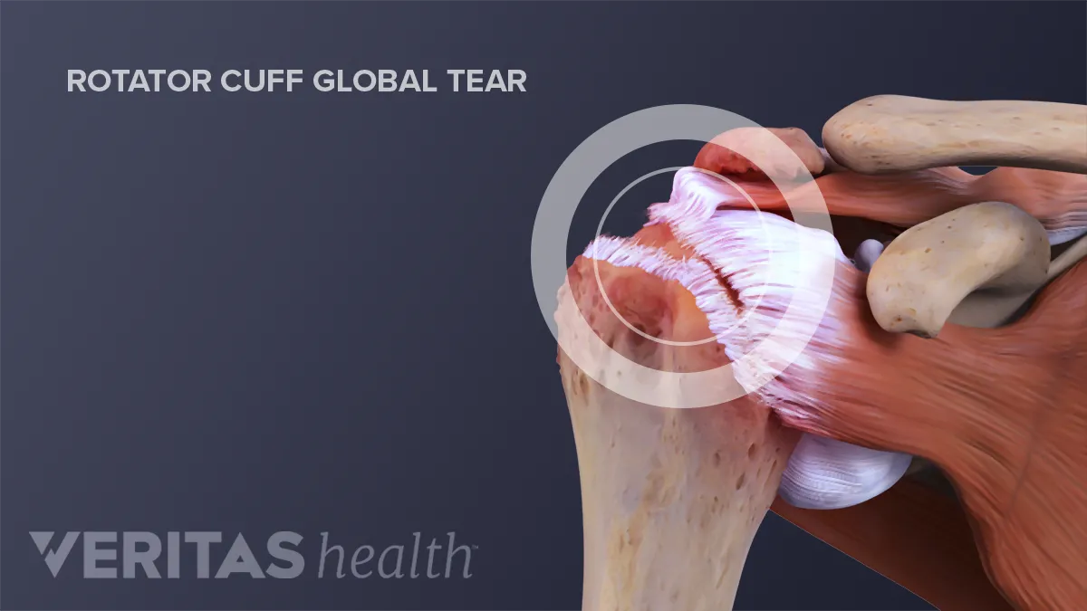 Rotator Cuff Tears - OrthoInfo - AAOS
