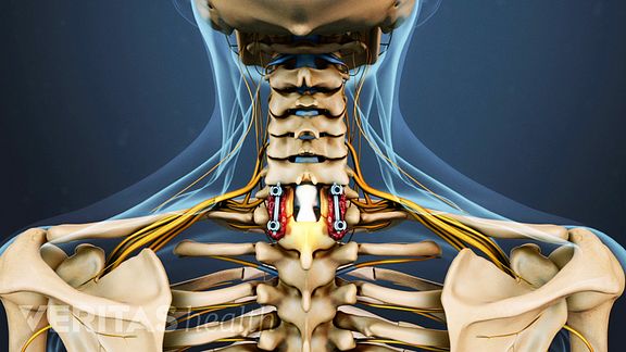 Cervical Laminectomy
