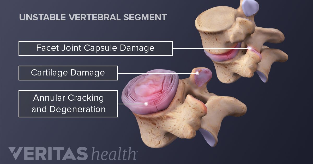 Spinal Osteoarthritis Risk Factors