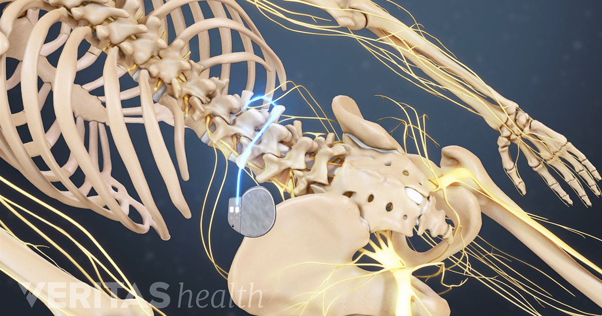 Advantages Of Spinal Cord Stimulation