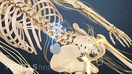 Posterior view of the lower back showing the spinal cord stimulator implement.