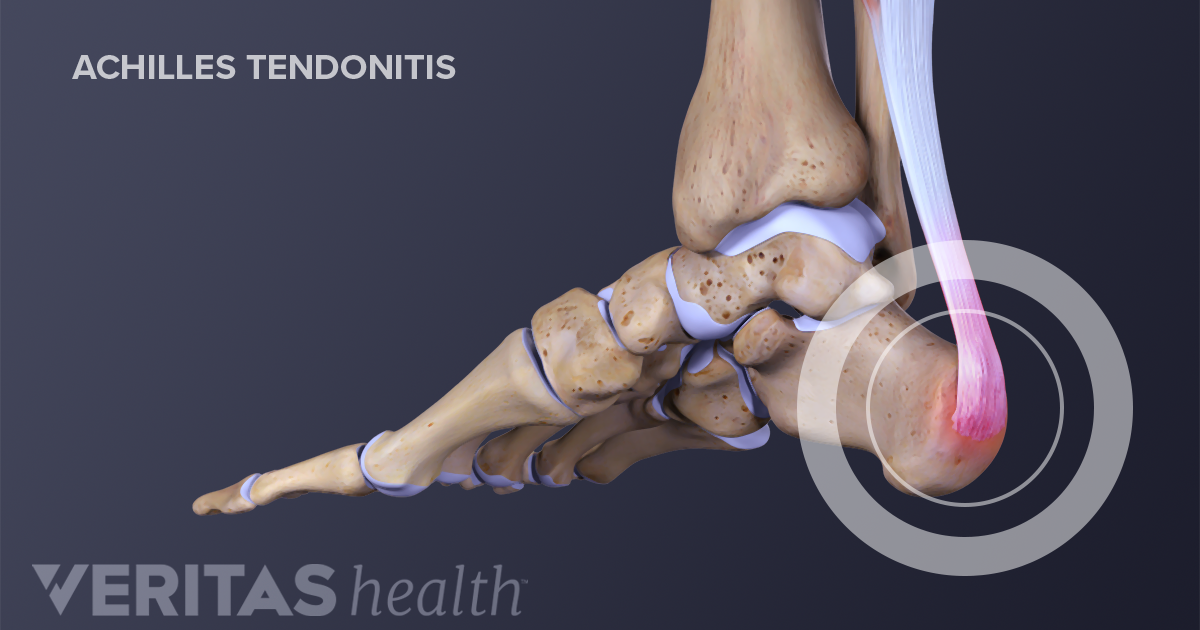 achilles tendon bursitis symptoms