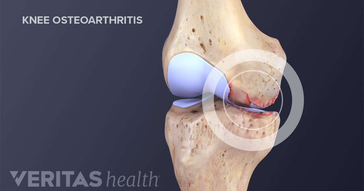 5 Telltale Symptoms of Arthritis: Damon Christian Kimes, MD: Interventional Pain Management