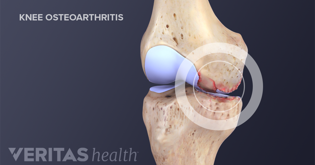 osteoarthritis fájdalom a gerinc alsó részén