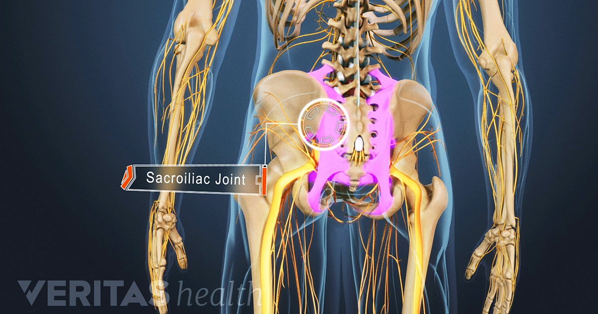 4 Types of Arthritis That Cause Sacroiliac Joint Pain
