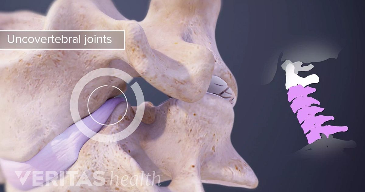 uncovertebral arthrosis