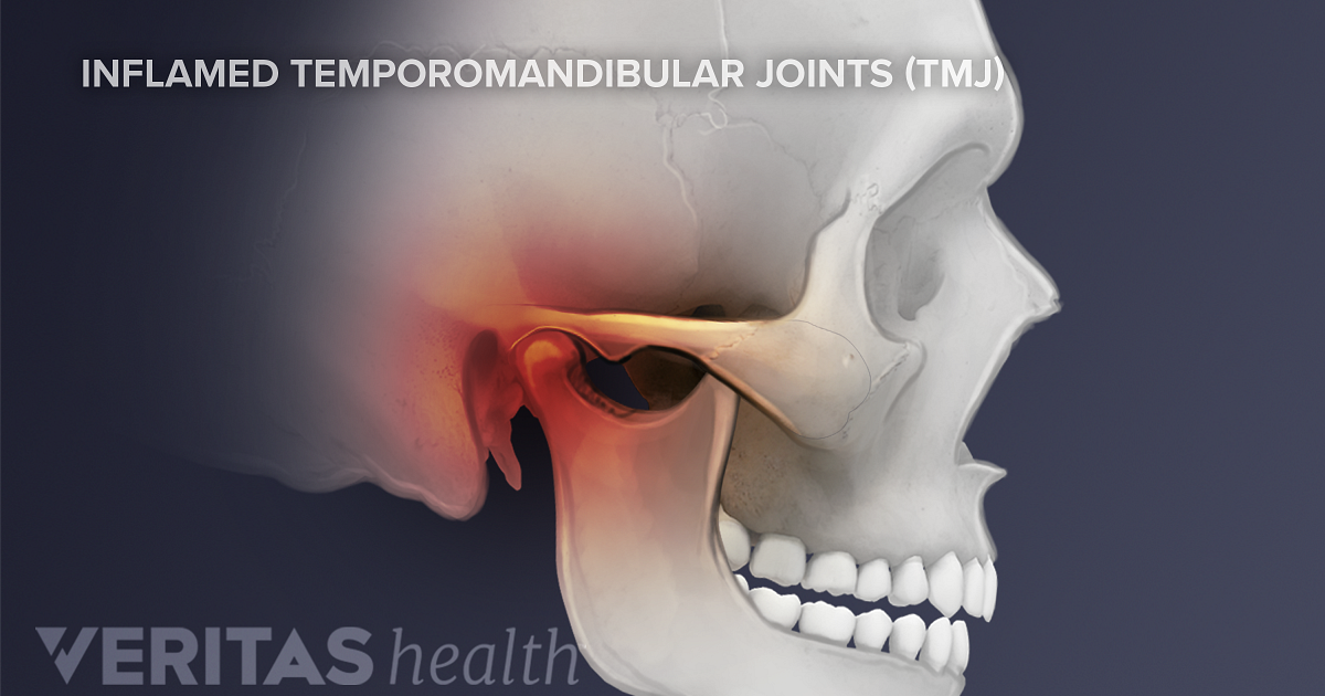 Symptoms Of Temporomandibular Joint (TMJ) Disorders