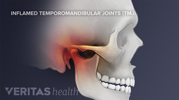 Symptoms Of Temporomandibular Joint (TMJ) Disorders