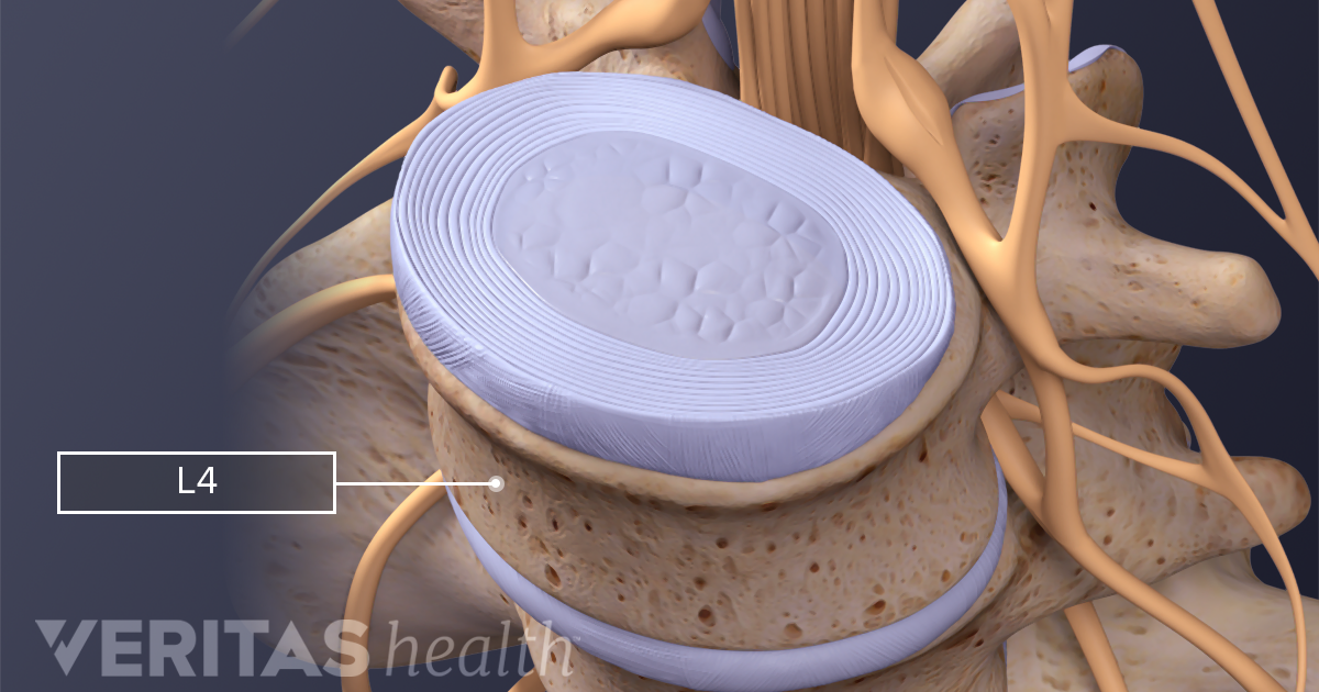 Top 23 treatment for l3 l4 disc herniation in 2022 - Oanhthai