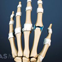 Dorsal view of the hand highlighting the fluid in the finger joints.