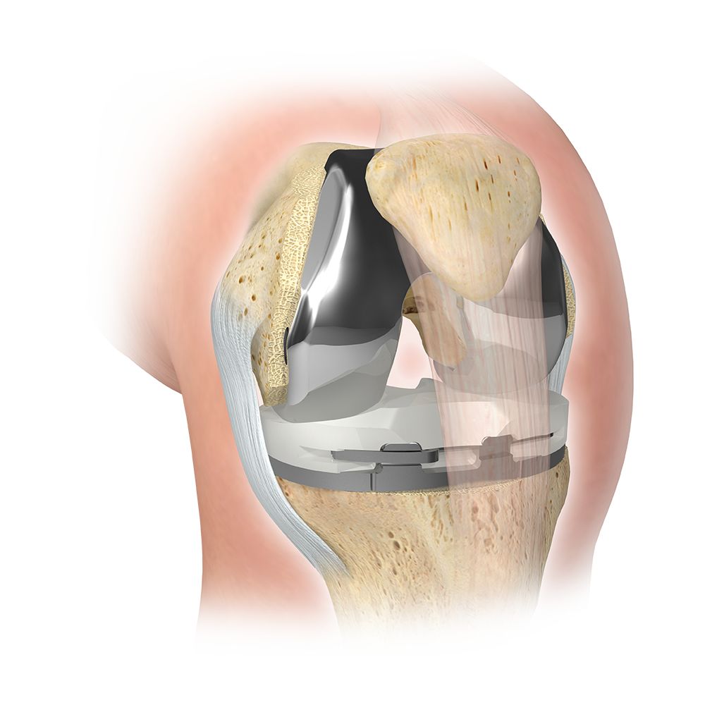 Zimmer Biomet - Knee Replacement