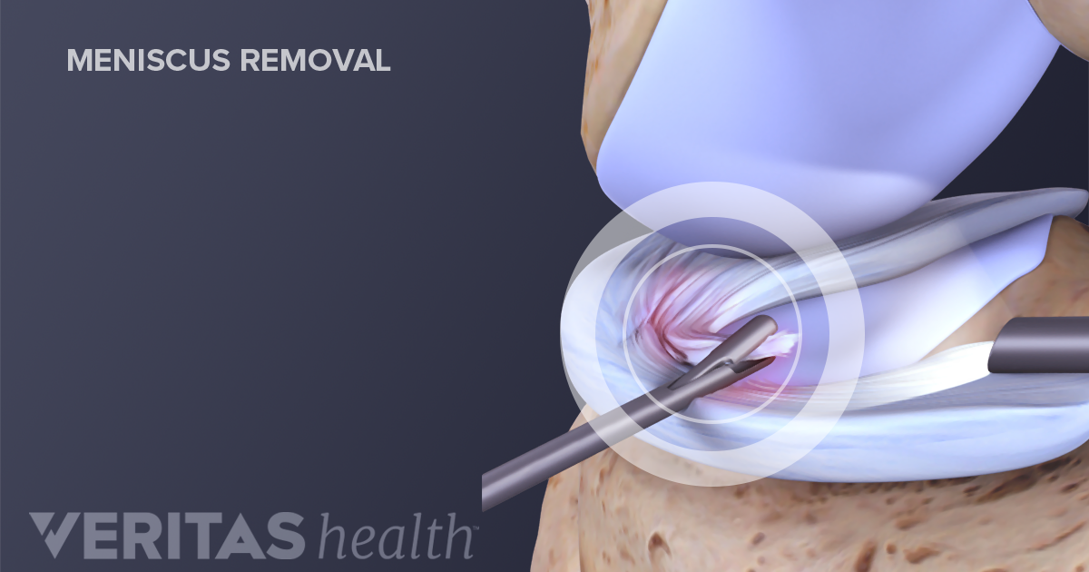 Meniscal Tear Treatment