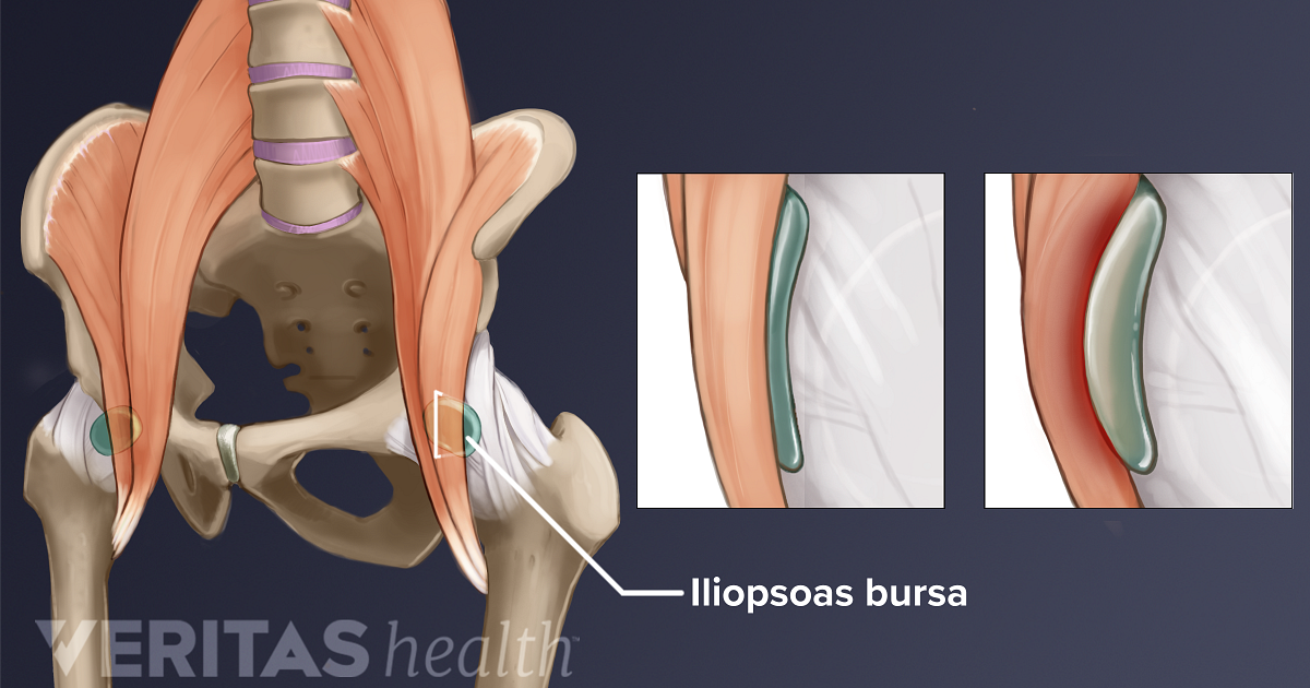 bursitis iliopsoas symptoms toate numele de unguente din articulații