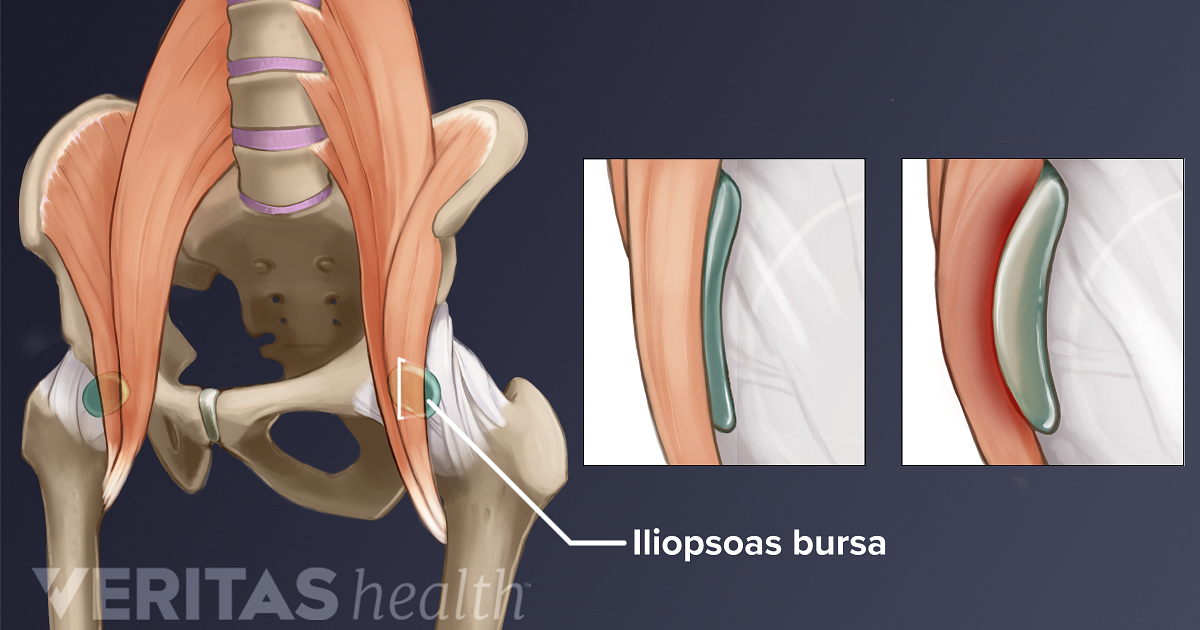 bursitis iliopsoas treatment)