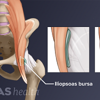 Anterior view of the pelvis labeling a iliopsoas bursitis in the hip joint.