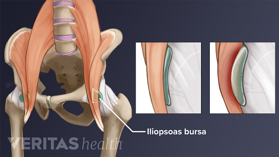 Anterior view of the pelvis highlighting the iliopsoas bursa
