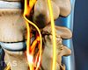 Lumbar Spinal Stenosis Video