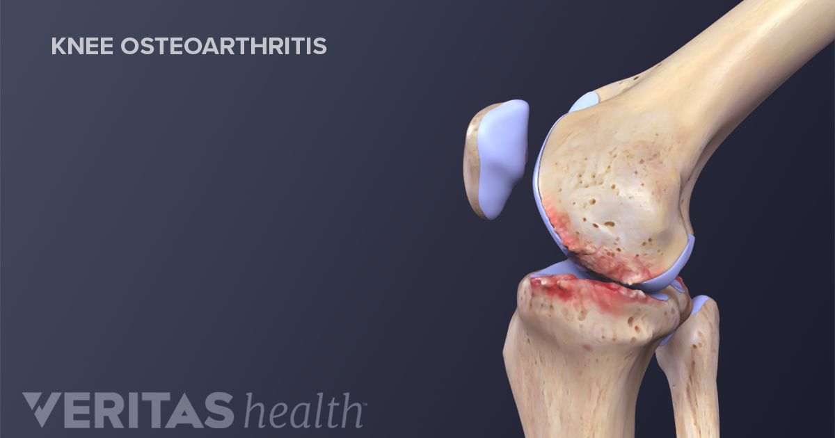 Home Treatments To Decrease Knee Osteoarthritis Symptoms