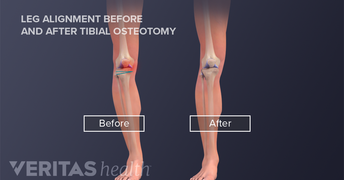 Osteotomy Definition | Defined by Arthritis-Health