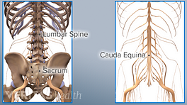 Side by side illustration of lumbar spine and sacrum and cauda equina nerves