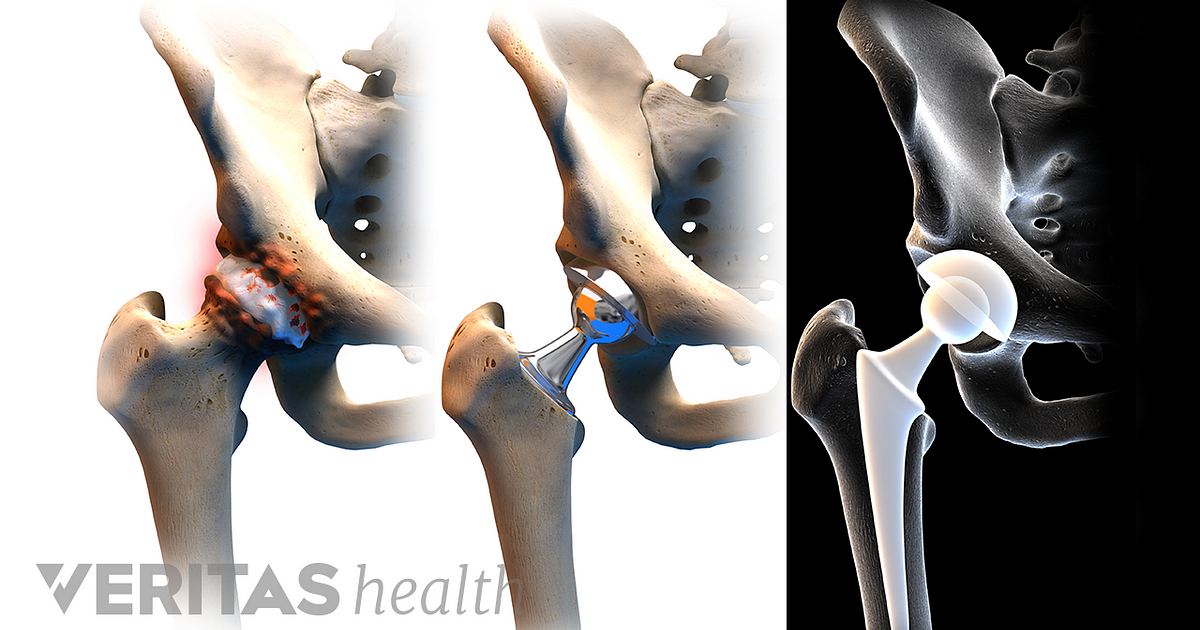 Advantages And Disadvantages Of Anterior Hip Replacement