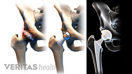 3 stages of a hip replacement, first inset shows an unhealthy hip joint, second inset shows the replaced hip joint, the third inset shows an xray of the hip replacement