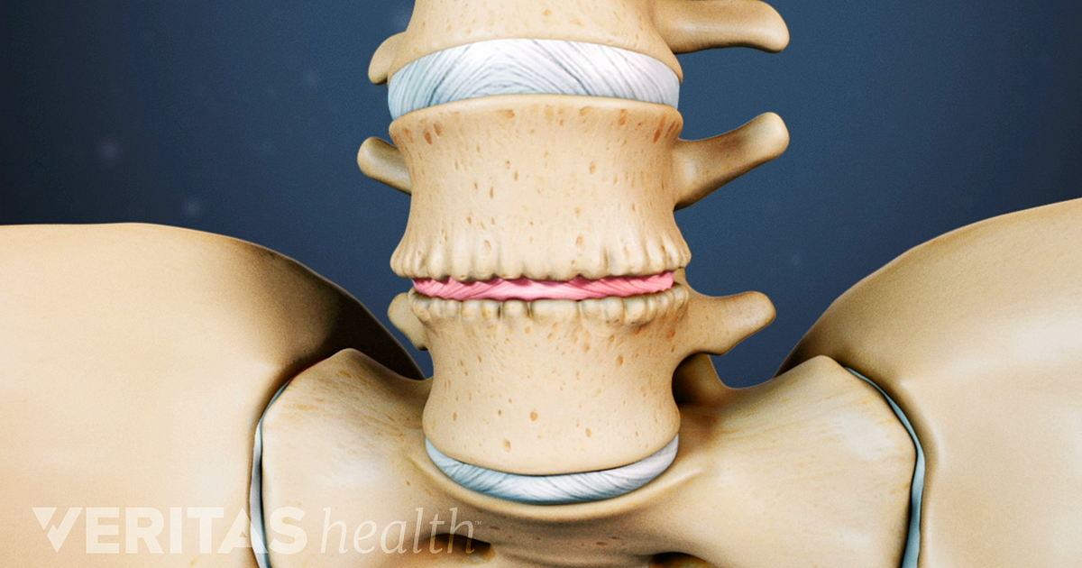 Degenerative Disc Disease Progression Over Time