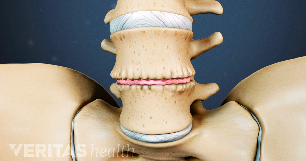 Degenerative Disc Disease Progression Over Time degenerative-disc-disease-progression-over-time