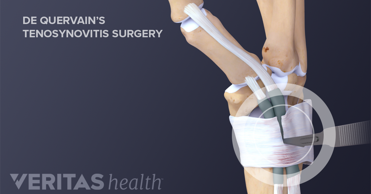 de quervain surgery cost australia