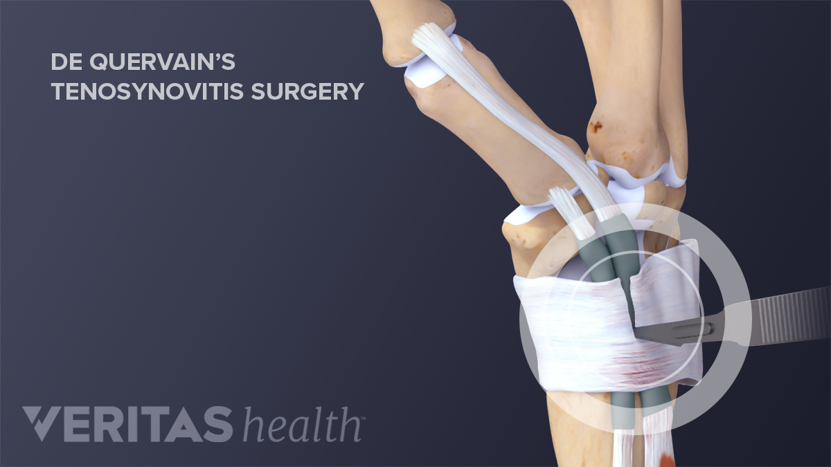 de quervain syndrome surgery recovery fájdalom a csontokban és ízületekben hideg hatására
