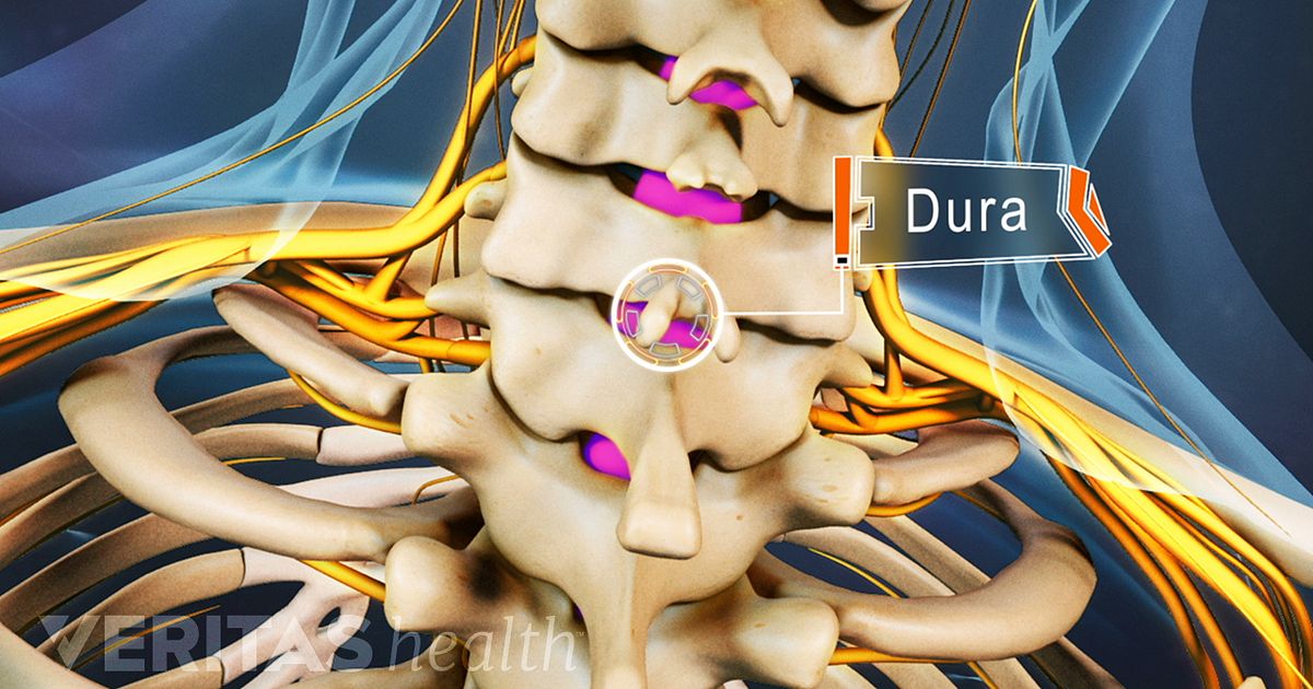 Cervical Epidural Steroid Injection Video 