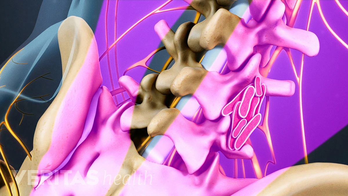 Bone Growth Stimulators Promote bone growth in difficult to heal