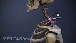 骷髅的头部、颈部和肩部的插图，在C7和T1椎骨上有高光。