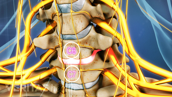 Understanding Cervical Herniated Discs