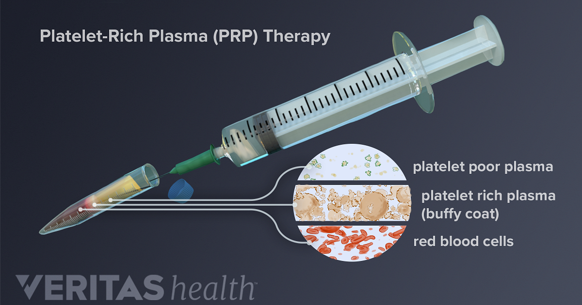 Platelet-Rich Plasma Injection Procedure