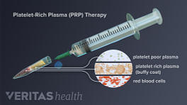 Medical illustration of the composition of a PRP injection