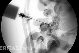 Steroid injection spine risks