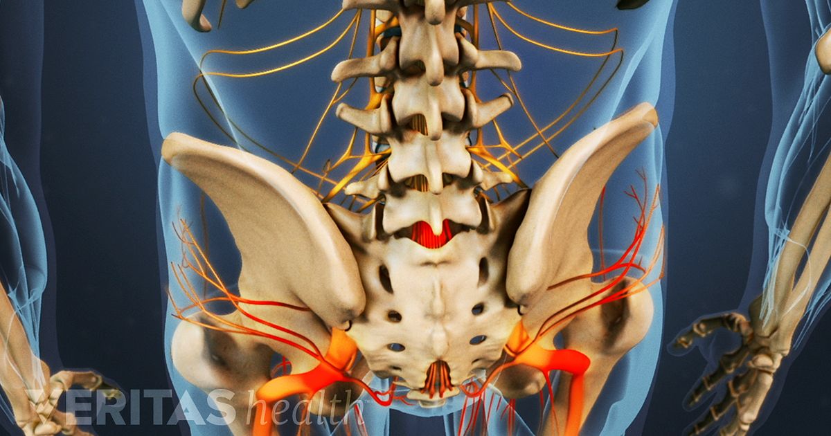 Isthmic Spondylolisthesis Video