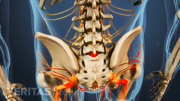 Isthmic Spondylolisthesis Video