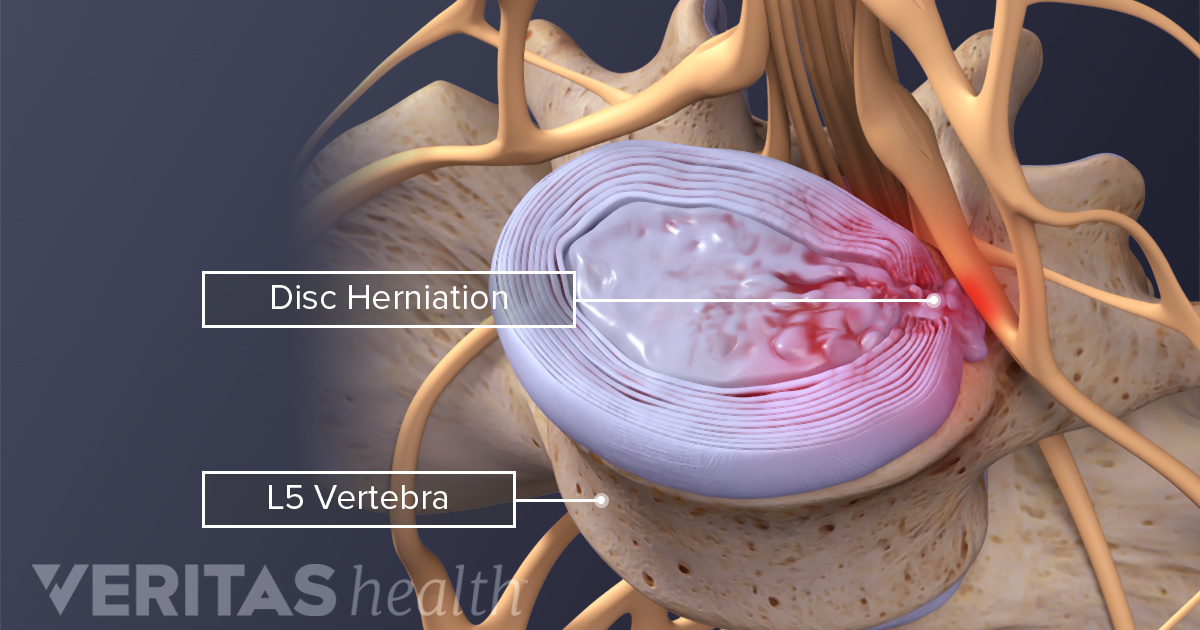 Lumbar Herniated Disc Symptoms