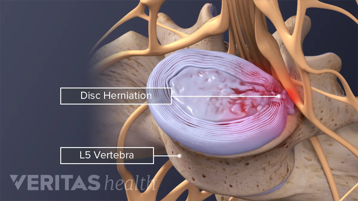 Bulging disk in back: What is it, pictures, symptoms, and treatment