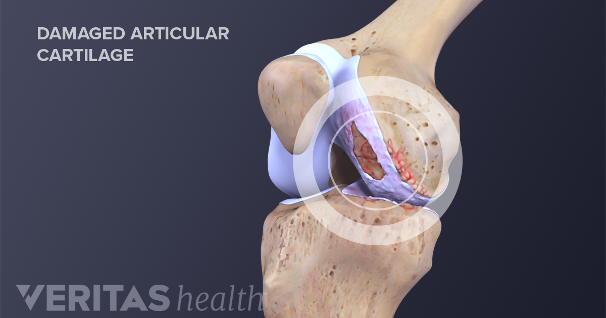 knee-cartilage-repair-regeneration-and-replacement