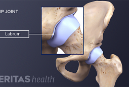 3 Types of Snapping Hip Syndrome