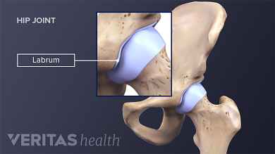 Coping With Hip Labral Tears