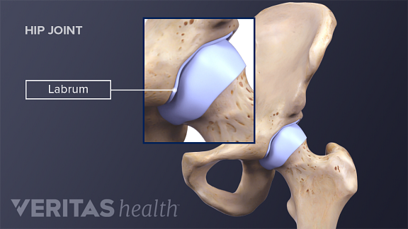 The hip labrum is a ring of cartilage surrounding the hip socket