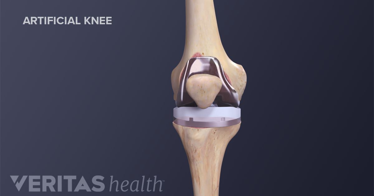 Knee Replacement Recovery Timeline