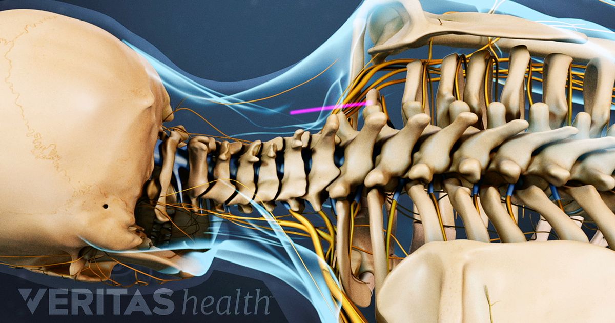 Anterior Cervical Corpectomy Spine Surgery